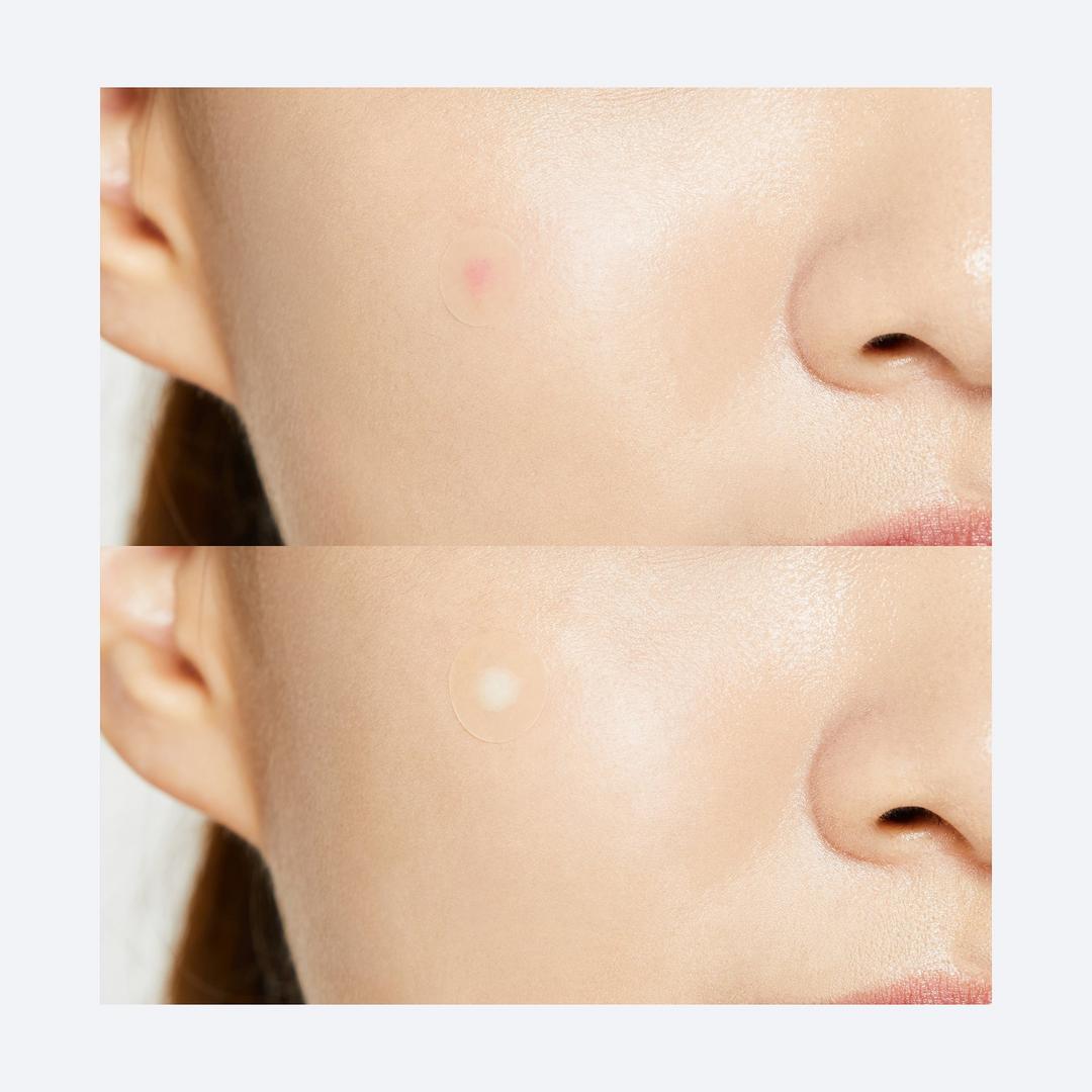 Acne Pimple Master Patch